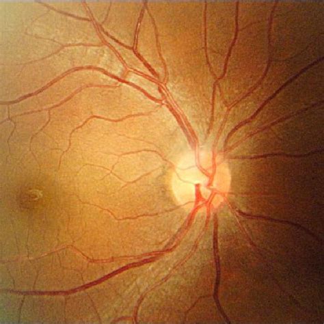 The primary conjugate gaze position is perfect as the eyelid position ...