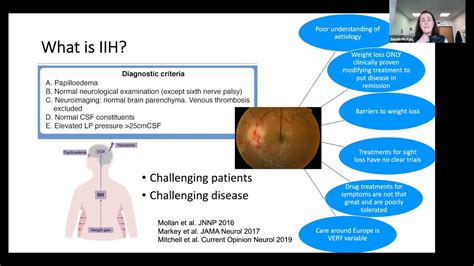 IDIOPATHIC INTRACRANIAL HYPERTENSION – PATHOPHYSIOLOGY AND CSF ...