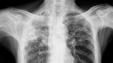 IMMIGRATION X-RAY FOR TUBERCULOSIS - Mayfair Diagnostics