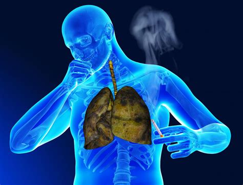 Lung Cancer Pleural Effusion