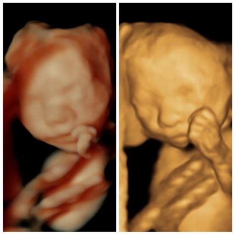 22 week 3D Ultrasound Pictures - A Date With Baby