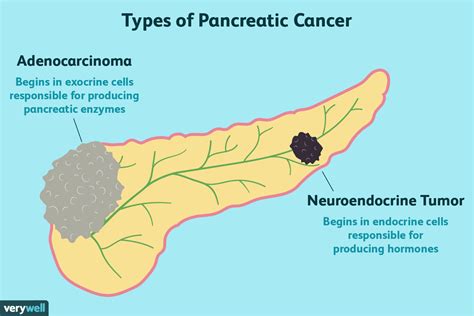 Types Of Pancreatic Cancer