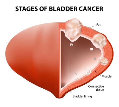 Non-Invasive Diagnostic Strategies for Bladder Cancer