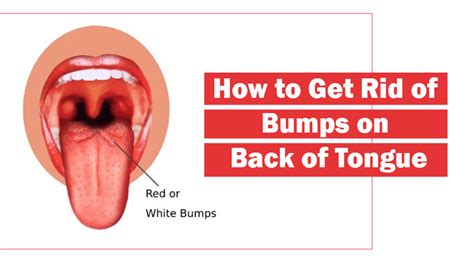 How To Get Rid Of Bumps On Tongue - Lordunit28