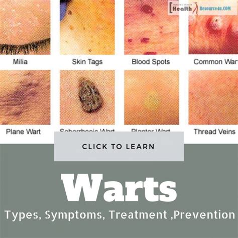 Warts Types, Symptoms, Treatment And Its Preventing Measures