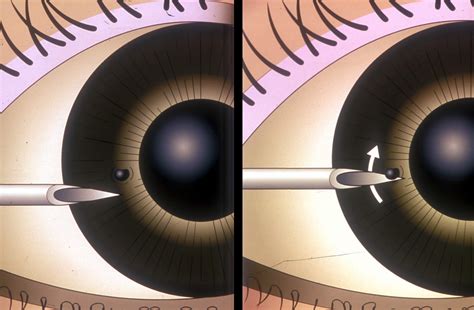 Community Eye Health Journal » How to remove a corneal foreign body