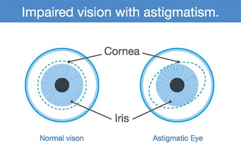 Astigmatism Eye