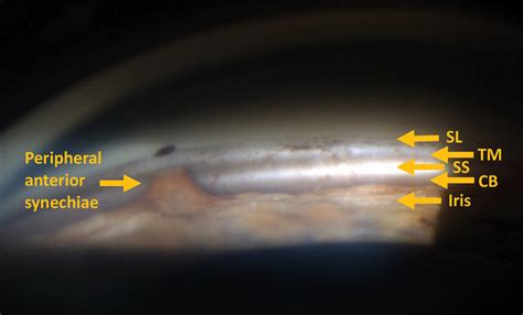 Gonioscopy: A Simple Tool, Too Often Forgotten