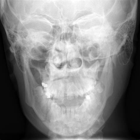 Mandibular Fracture X Ray