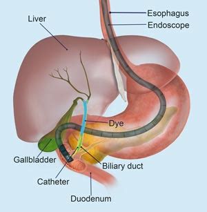 Endoscopic Retrograde Cholangiopancreatography Cypress TX | Digestive ...