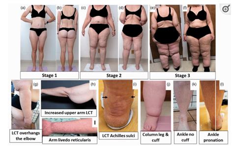 Lipedema: Genes, Root Causes, Possible Solutions - Elfprojekt