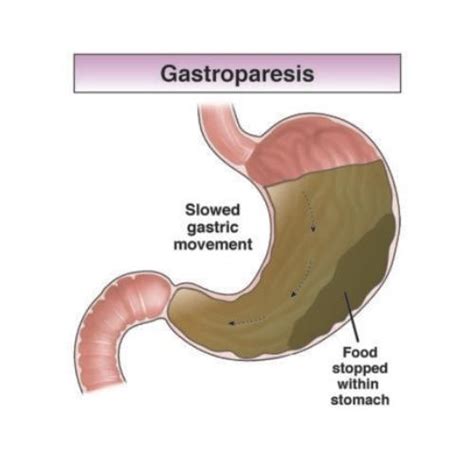 Gastroparesis: nutrition therapy - AGA GI Patient Center