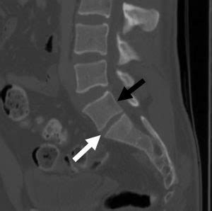 Lumbar sacralization