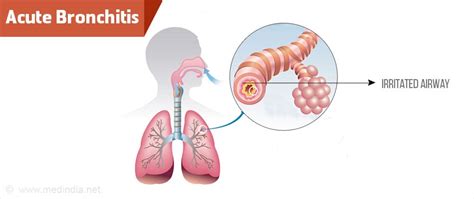 Acute Bronchitis - Causes, Symptoms, Diagnosis, Treatment, Prevention