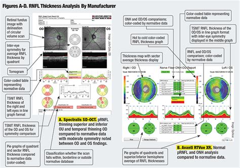 The Anatomy of an OCT Scan