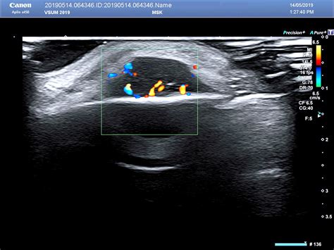 VIETNAMESE MEDIC ULTRASOUND: CASE 553: MANTLE CELL LYMPHOMA, DR PHAN ...