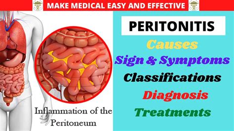 PERITONITIS, Anatomy, Causes, Sign and Symptoms, Classifications ...