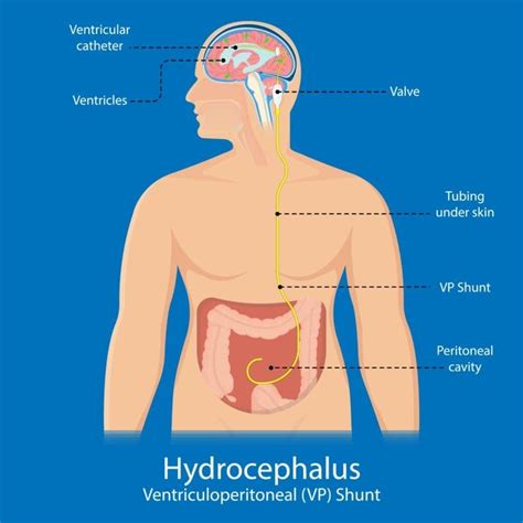 How Does a VP (Ventriculoperitoneal) Shunt Work » Fort Worth ...