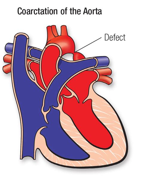 Coarctation of the Aorta (CoA) | American Heart Association