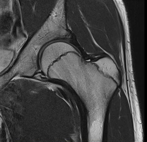 6-fai-paediatric-mri-hip - MRI at Melbourne Radiology Clinic