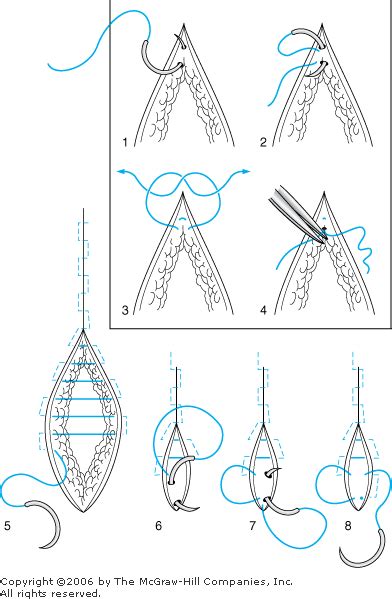 17. Suturing Techniques and Wound Care - Clinicians Pocket Reference ...