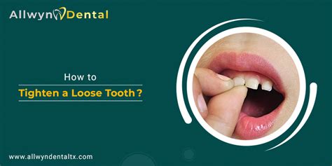 Tooth Loose : How to Save and Tighten a Loose Tooth হেলদি-স্পোর্টস