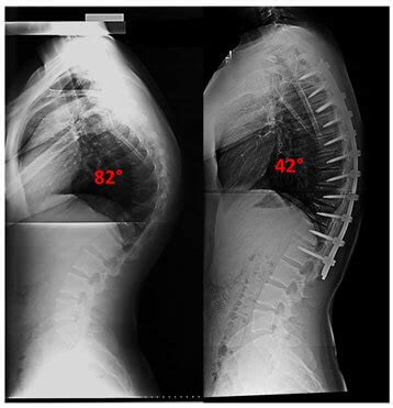 Scheuermann’s Kyphosis - Scoliosis and Spine Associates