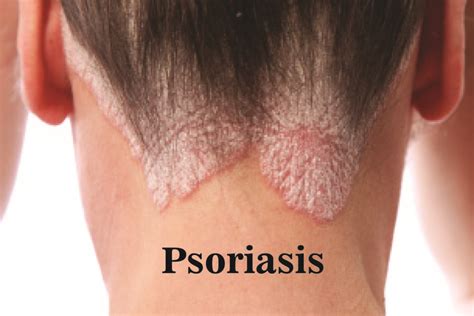 Psoriasis : Symptoms, Causes and Treatment - Dr. Anki Reddy's