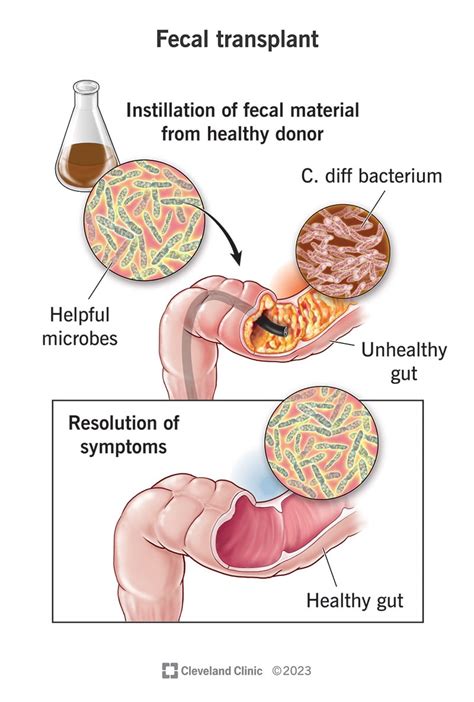 Fecal Transplant: What It Is, What It Treats, Procedure & Risks