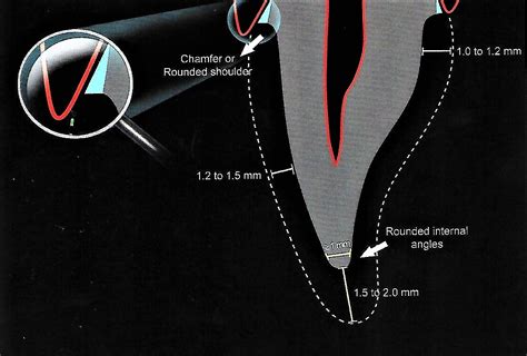 Anterior Crown Preparation | Dental Esthetics