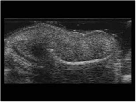 Head and Neck | 4.5 Miscellaneous : Case 4.5.6 Ear | Ultrasound Cases