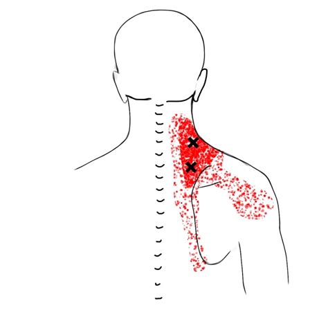 Trigger Points: Levator Scapula Trigger Points and Referral Patterns