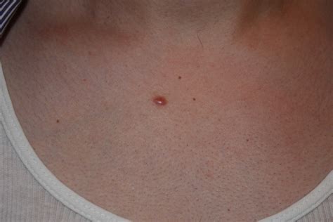 papular-keloid - Keloid Removal Expert - New York