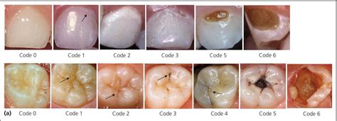 12: Diagnosis and Management of Dental Caries | Pocket Dentistry