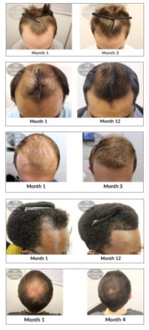 Hair Loss Treatments Men