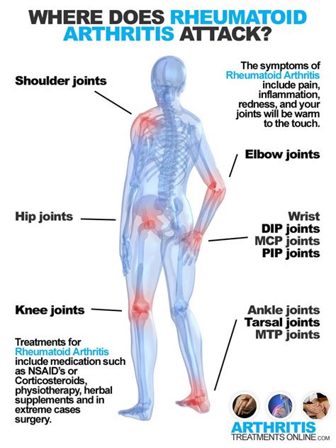 53 best Rheumatoid Arthritis images on Pinterest | Health, Rheumatoid ...