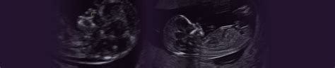 Nuchal Translucency Scan: You window to a healthy pregnancy