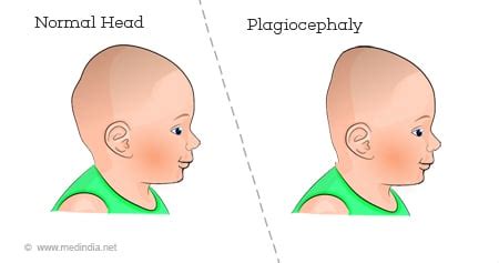 Plagiocephaly, Positional Plagiocephaly, Flat Head, 45% OFF