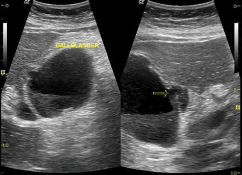 gallbladder perforation | pacs