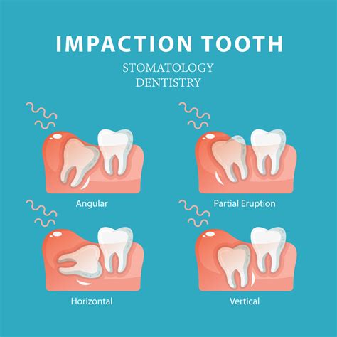 What Problems Can Impacted Wisdom Teeth Cause? Family, General Dentist ...