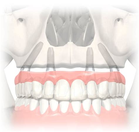 All-On-4 Implant