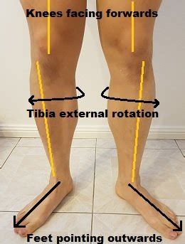 How to fix Duck feet posture - Posture Direct | Duck feet, Foot ...