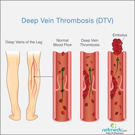 Deep Vein Thrombosis, DVT Symptoms, Causes And, 53% OFF