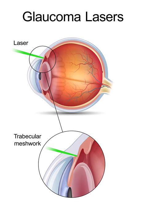 Glaucoma Surgery - La Jolla, CA