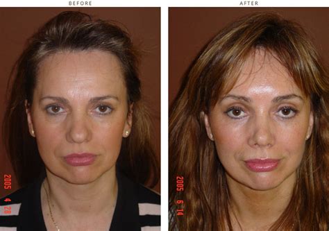 Mini Face Lift – Before and After Pictures * | Dr Turowski - Plastic ...