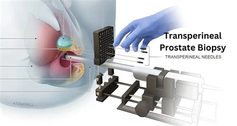 What Is a Transperineal Prostate Biopsy? Revealing the Procedure ...