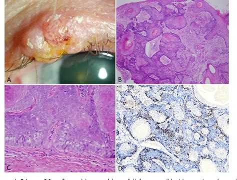 Figure 1 from Eyelid trichilemmal carcinoma | Semantic Scholar