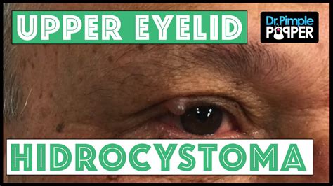 Upper Eyelid Hidrocystoma - YouTube