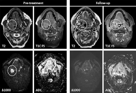 Tumor response confirmed on diffusion. A 54-year-old patient with a ...