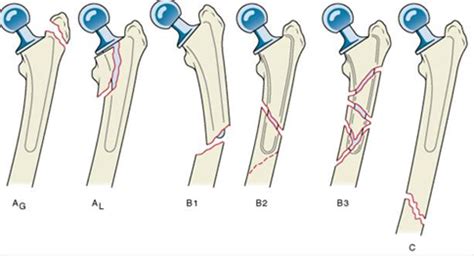 THA Periprosthetic Fracture - Recon - Orthobullets